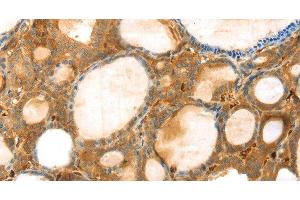 Immunohistochemistry of paraffin-embedded Human thyroid cancer using TMPRSS11F Polyclonal Antibody at dilution of 1:30 (TMPRSS11F antibody)