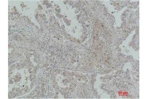 Immunohistochemistry (IHC) analysis of paraffin-embedded Human Lung Carcinoma using MICU1 Monoclonal Antibody.