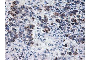 Immunohistochemical staining of paraffin-embedded Carcinoma of Human lung tissue using anti-PDE4B mouse monoclonal antibody. (PDE4B antibody)