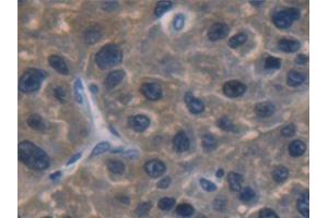 Detection of ALDH1A1 in Human Liver cancer Tissue using Polyclonal Antibody to Aldehyde Dehydrogenase 1 Family, Member A1 (ALDH1A1) (ALDH1A1 antibody  (AA 2-501))