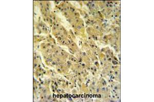 PSG7 Antibody IHC analysis in formalin fixed and paraffin embedded hepatocarcinoma followed by peroxidase conjugation of the secondary antibody and DAB staining. (PSG7 antibody  (C-Term))