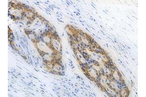 ABIN6264918 and ABIN6277937 at 1/100 staining human pancreatic carcinoma by IHC-P.