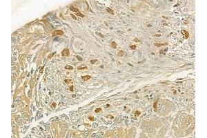 ABIN6258755 and ABIN6273696 at 1/100 staining human tongue carcinoma by IHC-P. (SETDB2 antibody  (N-Term))