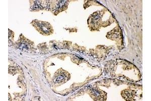 IHC testing of FFPE human prostate cancer with DBI antibody at 1ug/ml. (Diazepam Binding Inhibitor antibody  (AA 2-187))