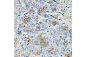 Immunohistochemistry of paraffin-embedded human liver cancer using SERPINA1 antibody. (SERPINA1 antibody  (AA 25-315))