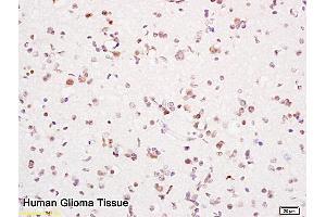 Formalin-fixed and paraffin embedded human brain tissue labeled with Anti-PCNA Polyclonal Antibody, Unconjugated (ABIN676583) at 1:200 followed by conjugation to the secondary antibody and DAB staining (PCNA antibody  (AA 151-261))