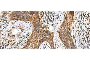 Immunohistochemistry of paraffin-embedded Human esophagus cancer tissue using TTR Polyclonal Antibody at dilution of 1:50(x200) (TTR antibody)