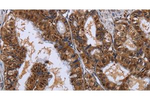 Immunohistochemistry of paraffin-embedded Human esophagus cancer using LTA4H Polyclonal Antibody at dilution of 1:30 (LTA4H antibody)