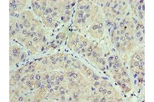 Immunohistochemistry of paraffin-embedded human liver cancer using ABIN7153848 at dilution of 1:100 (GAN antibody  (AA 1-240))