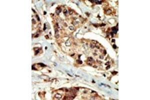 Formalin-fixed and paraffin-embedded human cancer tissue (breast carcinoma) reacted with the primary antibody, which was peroxidase-conjugated to the secondary antibody, followed by DAB staining. (STK16 antibody  (N-Term))