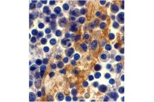 Immunohistochemistry of CD209 in human lymph node tissue with CD209 polyclonal antibody  at 10 ug/mL .