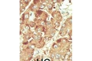 Formalin-fixed and paraffin-embedded human cancer tissue reacted with the primary antibody, which was peroxidase-conjugated to the secondary antibody, followed by DAB staining. (Nemo-Like Kinase antibody  (C-Term))