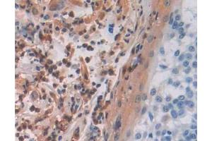 DAB staining on IHC-P; Samples: Human Skin cancer Tissue (MAEA antibody  (AA 136-379))
