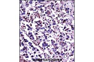 CN11 Antibody (Center) (13870c)immunohistochemistry analysis in formalin fixed and paraffin embedded human testis carcinoma followed by peroxidase conjugation of the secondary antibody and DAB staining. (CAPN11 antibody  (AA 409-438))