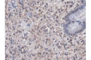 DAB staining on IHC-P; Samples: Human Colorectal cancer Tissue (PTTG1 antibody  (AA 2-202))