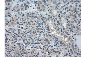 Immunohistochemical staining of paraffin-embedded Carcinoma of pancreas tissue using anti-LDHAmouse monoclonal antibody. (Lactate Dehydrogenase A antibody)