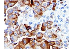 Formalin-fixed, paraffin-embedded human Melanoma stained with NGFR Mouse Monoclonal Antibody (NGFR5). (NGFR antibody)