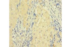 Immunohistochemistry of paraffin-embedded human liver cancer using ABIN7173813 at dilution of 1:100 (FASL antibody  (AA 103-281))