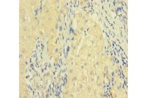 Immunohistochemistry of paraffin-embedded human liver cancer using ABIN7173813 at dilution of 1:100 (FASL antibody  (AA 103-281))