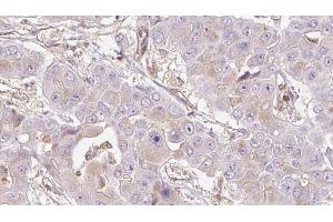 ABIN6272726 at 1/100 staining Human liver cancer tissue by IHC-P. (OR4D5 antibody)