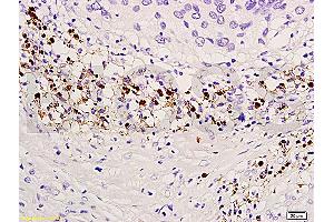 Formalin-fixed and paraffin embedded human endometrium carcinoma labeled with Anti-TIMP-4 Polyclonal Antibody, Unconjugated (ABIN668376) at 1:300, followed by conjugation to the secondary antibody and DAB staining (TIMP4 antibody  (AA 161-224))