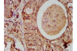 IHC image of ABIN7160090 diluted at 1:400 and staining in paraffin-embedded human cervical cancer performed on a Leica BondTM system. (MAD2L1 antibody  (AA 2-205))