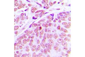 Immunohistochemical analysis of CEP70 staining in human breast cancer formalin fixed paraffin embedded tissue section.