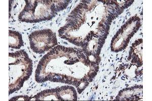 Immunohistochemical staining of paraffin-embedded Adenocarcinoma of Human colon tissue using anti-RFPL3 mouse monoclonal antibody. (RFPL3 antibody)