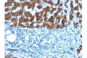 Formalin-fixed, paraffin-embedded human Hepatocellular Carcinoma stained with RBP1 (SPM442) (RBP4 antibody)