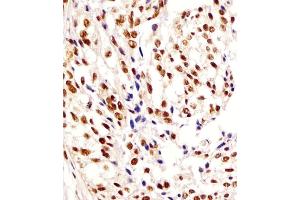 (ABIN6244112 and ABIN6578296) staining HNRNL2 in human breast carcinoma tissue sections by Immunohistochemistry (IHC-P - paraformaldehyde-fixed, paraffin-embedded sections). (HNRNPA1L2 antibody  (AA 22-56))