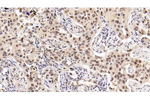 Detection of HDAC1 in Human Lung cancer Tissue using Monoclonal Antibody to Histone Deacetylase 1 (HDAC1) (HDAC1 antibody  (AA 1-482))