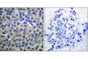 Immunohistochemistry analysis of paraffin-embedded human breast carcinoma, using SYK (Phospho-Tyr348) Antibody. (SYK antibody  (pTyr348))
