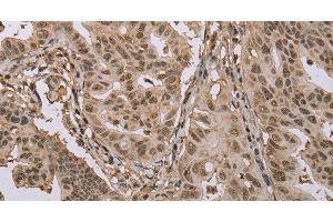 Immunohistochemistry of paraffin-embedded Human gastric cancer using CAB39 Polyclonal Antibody at dilution of 1:50 (CAB39 antibody)