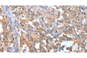 Immunohistochemistry of paraffin-embedded Human thyroid cancer tissue using NOD2 Polyclonal Antibody at dilution 1:40 (NOD2 antibody)