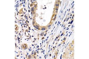 Immunohistochemistry of paraffin-embedded human stomach cancer using PTGIR antibody at dilution of 1:200 (400x lens).