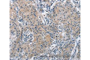 Immunohistochemistry of Human gastric cancer using TRIP4 Polyclonal Antibody at dilution of 1:50 (TRIP4 antibody)