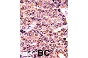 Formalin-fixed and paraffin-embedded human cancer tissue reacted with CDKN1A (phospho T145) polyclonal antibody  which was peroxidase-conjugated to the secondary antibody followed by AEC staining. (p21 antibody  (pThr145))