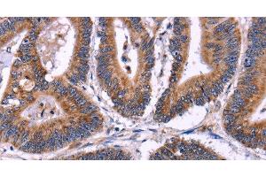 Immunohistochemistry of paraffin-embedded Human colon cancer using SIGLEC5 Polyclonal Antibody at dilution of 1:30 (SIGLEC5 antibody)