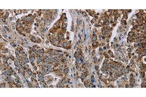 Immunohistochemistry of paraffin-embedded Human liver cancer using GOT2 Polyclonal Antibody at dilution of 1:50 (GOT2 antibody)