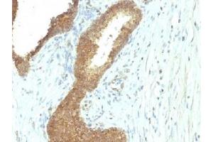 IHC testing of FFPE human colon carcinoma with Alkaline Phosphatase antibody (ALPL/597).
