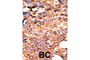 Formalin-fixed and paraffin-embedded human cancer tissue reacted with the primary antibody, which was peroxidase-conjugated to the secondary antibody, followed by AEC staining. (PANK3 antibody  (AA 150-181))