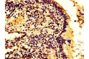 IHC image of ABIN7155213 diluted at 1:300 and staining in paraffin-embedded human lung cancer performed on a Leica BondTM system. (HMGB3 antibody  (AA 1-103))