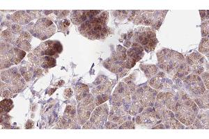 ABIN6273266 at 1/100 staining Human pancreas cancer tissue by IHC-P.