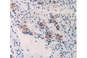IHC-P analysis of prostate gland cancer tissue, with DAB staining. (GALC antibody  (AA 375-535))