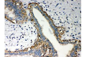 Anti- LYRIC Picoband antibody,IHC(P) IHC(P): Human Mammary Cancer Tissue (MTDH antibody  (AA 101-270))