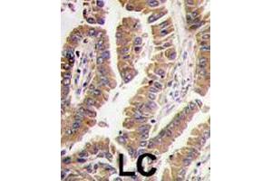 Formalin-fixed and paraffin-embedded human lung carcinoma tissue reacted with BMP4 polyclonal antibody  , which was peroxidase-conjugated to the secondary antibody, followed by DAB staining. (BMP4 antibody  (N-Term))