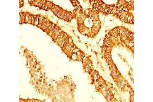Immunohistochemistry of paraffin-embedded human endometrial cancer using ABIN7158700 at dilution of 1:100 (KDM4C antibody  (AA 450-600))