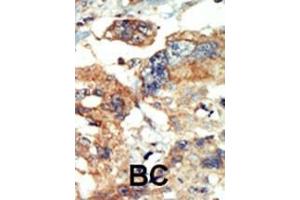 Formalin-fixed and paraffin-embedded human cancer tissue reacted with the primary antibody, which was peroxidase-conjugated to the secondary antibody, followed by AEC staining. (PI4KB antibody  (N-Term))