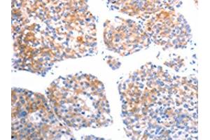 The image on the left is immunohistochemistry of paraffin-embedded Human liver cancer tissue using ABIN7192492(SLC44A1 Antibody) at dilution 1/25, on the right is treated with synthetic peptide. (SLC44A1 antibody)