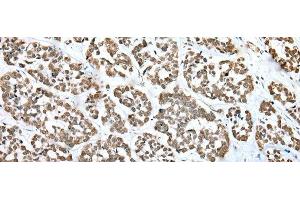 Immunohistochemistry of paraffin-embedded Human esophagus cancer tissue using ZNF486 Polyclonal Antibody at dilution of 1:50(x200) (ZNF486 antibody)